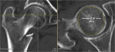 Evaluation of femoral head bone quality by Hounsfield units: A predictor of implant failure for intertrochanteric fractures after intramedullary nail fixation